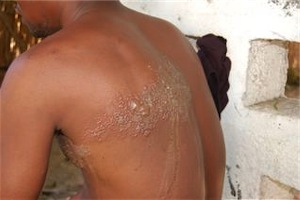 Malawian Burn Victim.